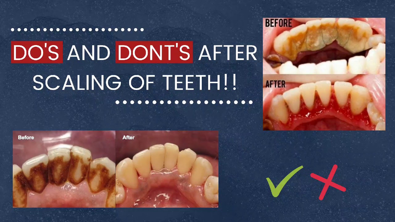 DO'S AND DONT'S AFTER SCALING OF TEETH | DENTO FRIEND