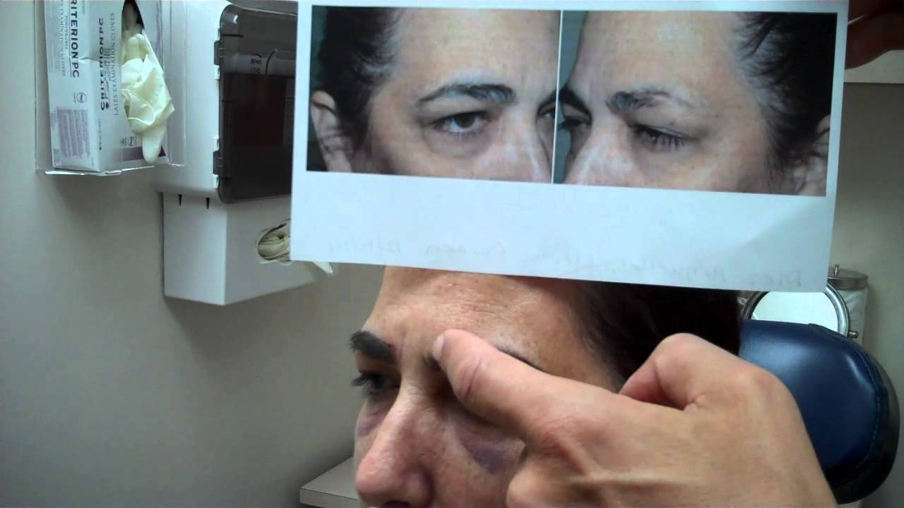 Eyebrow Transplant - Post-Op - Part II