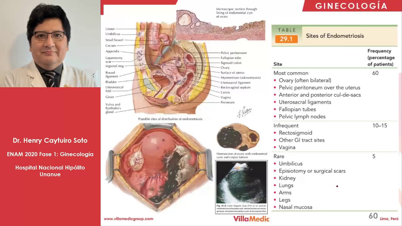 GINECO | Endometriosis - ENAM 2021