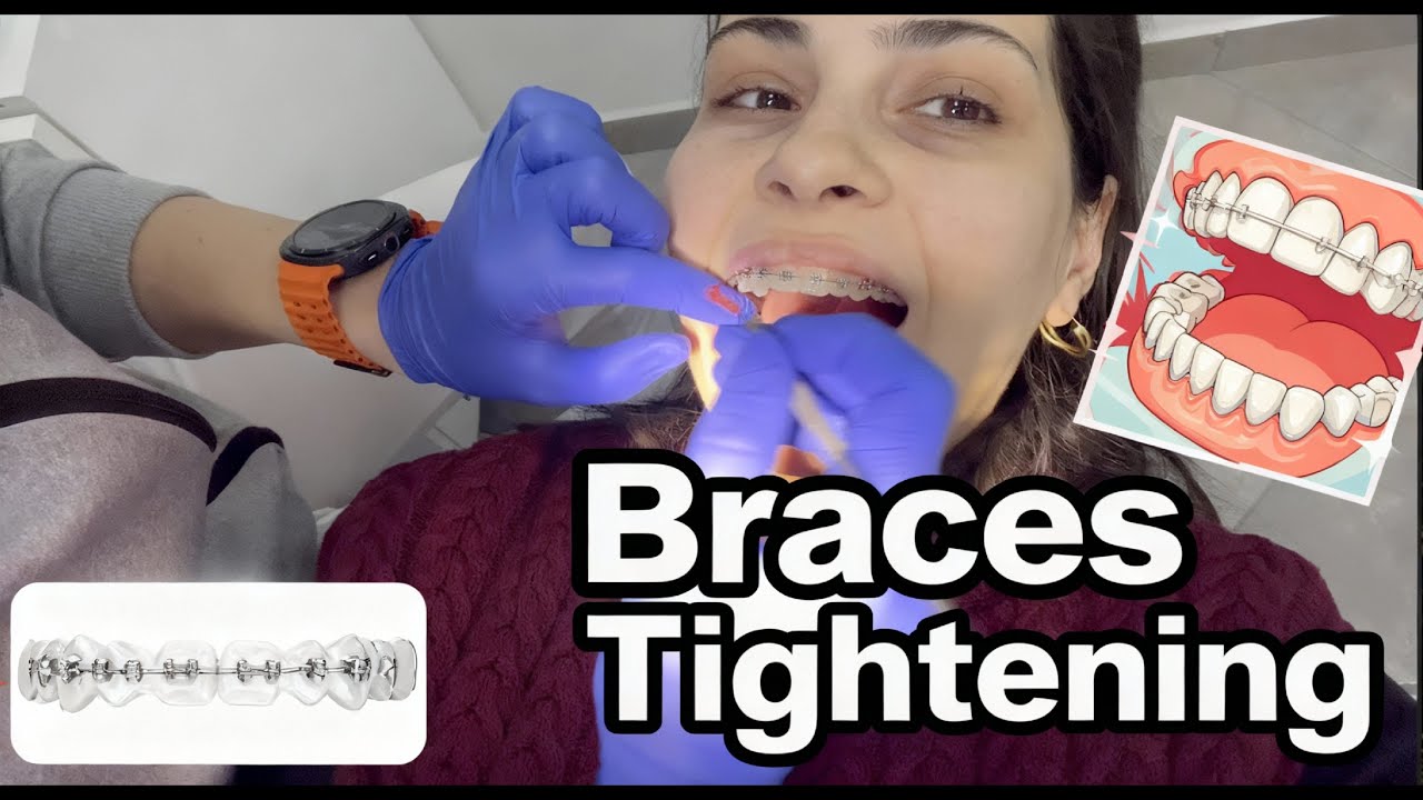 My Braces Journey | Tightening Day