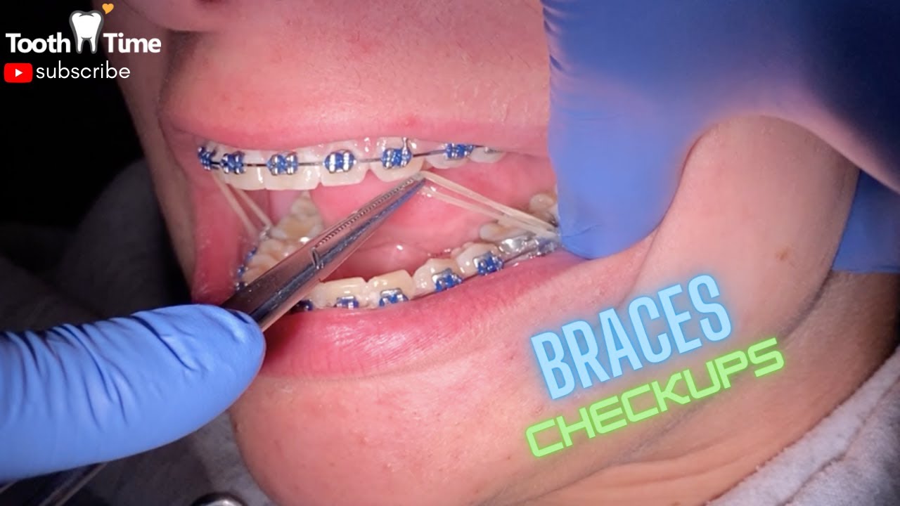 Braces Checkups |1 YEAR| First time getting Rubber bands - Tooth Time Family Dentistry New Braunfels