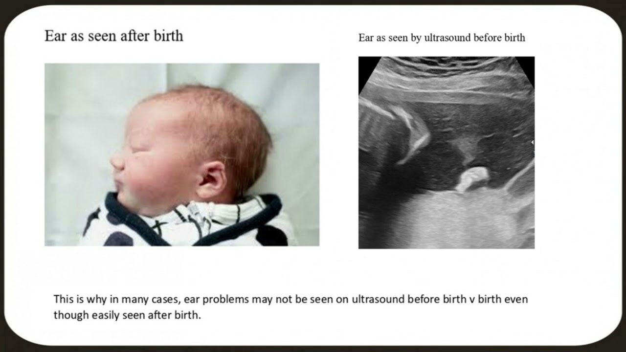 ALL ABMORMALITIES CANNOT BE DETECTED ON ULTRASOUND