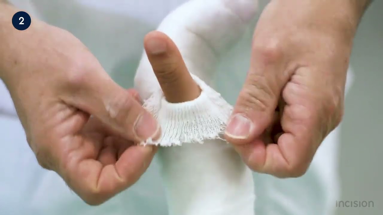 Radial gutter splint
