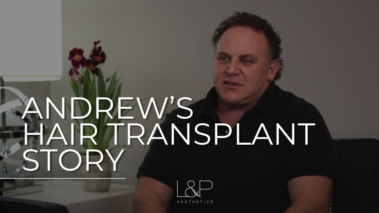 My Bay Area NeoGraft Hair Transplant Story - From Hair Loss to Restored Confidence