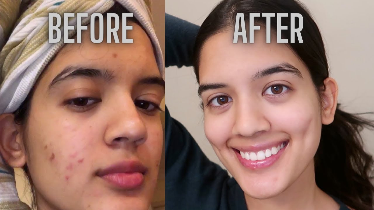 How I Cleared My Hormonal Acne & Scarring In $35 | Shivani Bafna