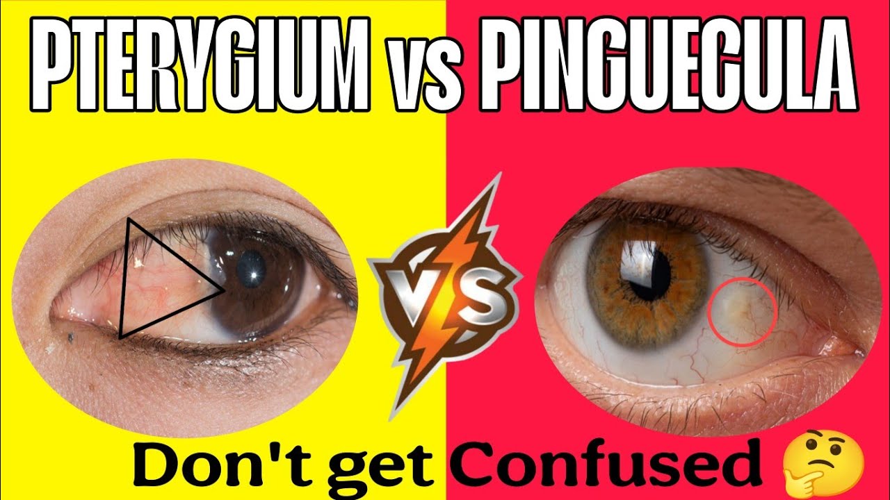 STOP Confusing PTERYGIUM and PINGUECULA The Dangers of Misdiagnosis