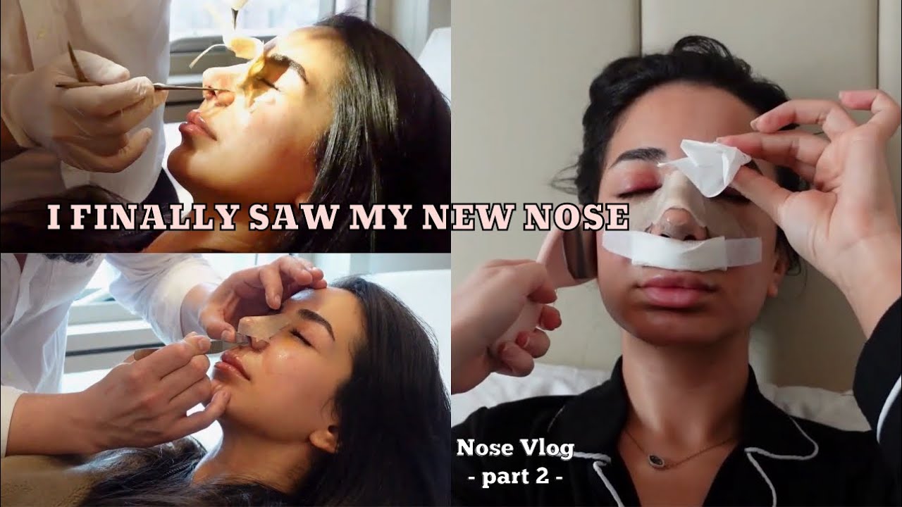 I GOT A NOSE JOB...AGAIN?! | CAST REMOVAL | DR EMRAH CELIK - NOSE JOB VLOG (PART 2)