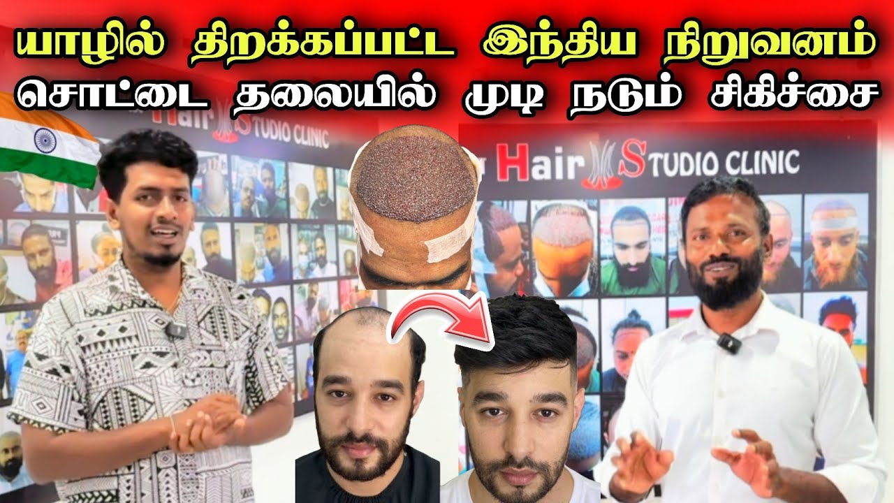 🔴இந்தியாவில் இருந்து யாழ்ப்பாணம் வந்த தலைமுடி மாற்று சிகிச்சை நிலையம் 😮🔥💇‍♂️ Hair Transplantation 🇮🇳