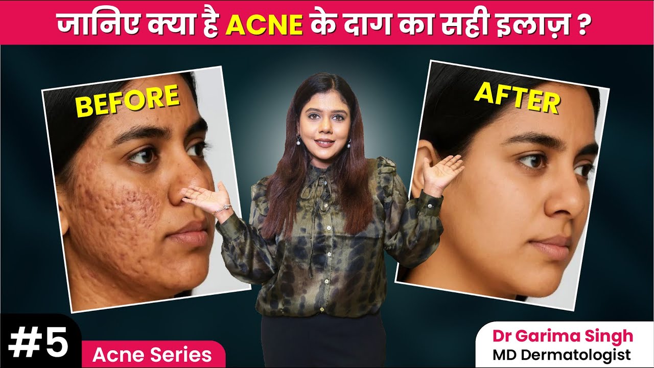 Kya Acne Scars Kabhi Theek Ho Sakte Hain? |  Acne scars kyu hote hain | Dermatologist
