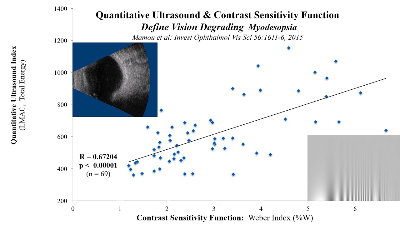 Vitrectomy Improves Visual Function in Multifocal Pseudophakia with Vision Degrading Myodesopsia