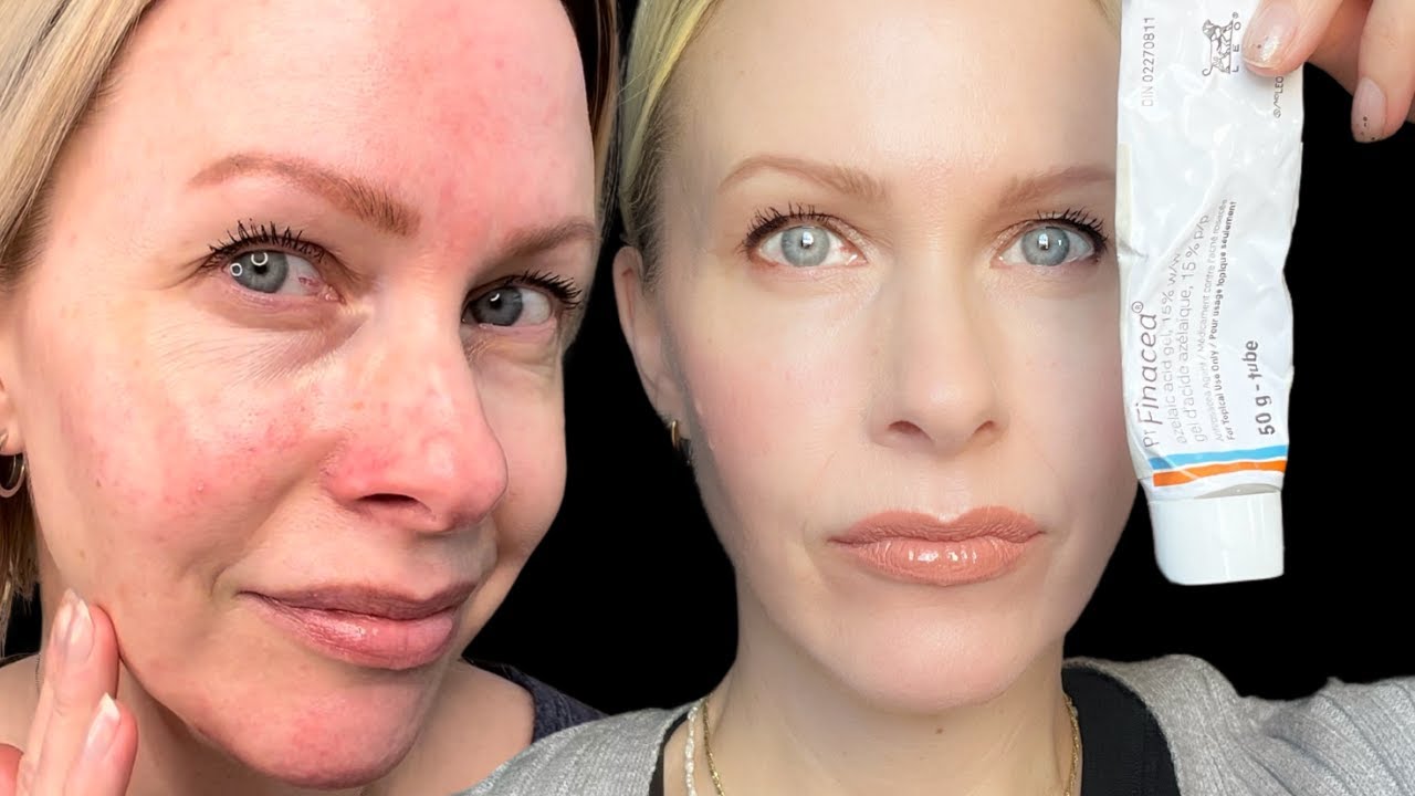 PRESCRIPTION Azelaic Acid update - 9 months later...