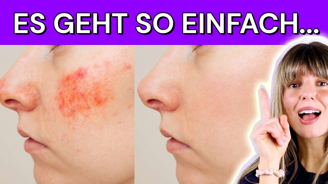Diese LEBENSMITTEL helfen bei Rosazea, Rötungen im Gesicht * (rote Flecken, Tipps)