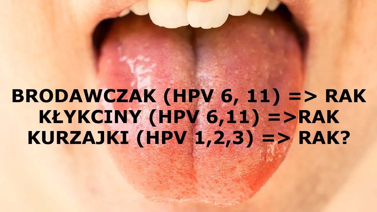 HPV - Czy istnieją TYPY NIEONKOGENNE? - nawet z kłykcin i brodawek może się rozwinąć rak?