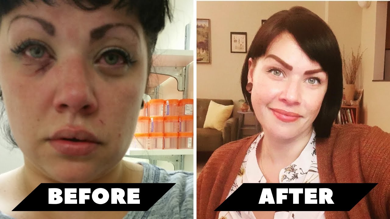 Woman Ends Severe Addiction Of 20+ Years After An Overdose Near Death Experience | NDE