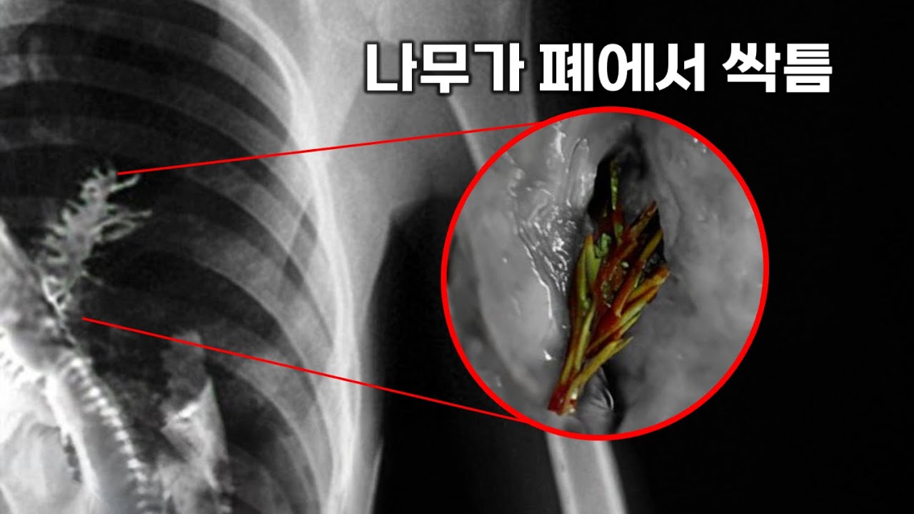 삼킨 씨앗이 몸 속에서 자라난 충격적인 이야기