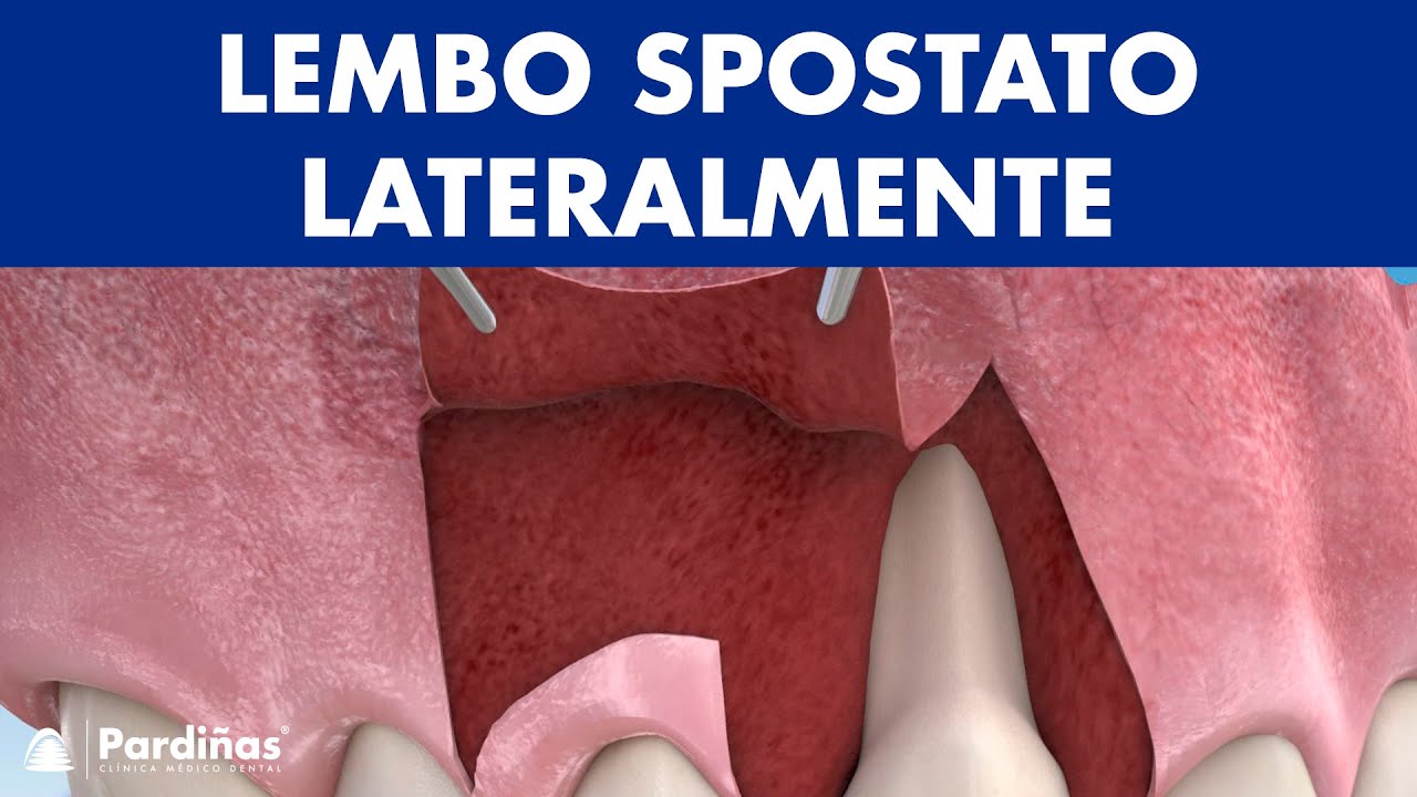 Lembo spostato lateralmente per la copertura radicolare ©