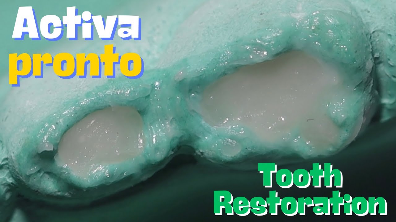 ACTIVA PRONTO 🔵 Tooth Restoration ⚪️ Stackable Composite 🟣 #atozkidsdental #toothisland