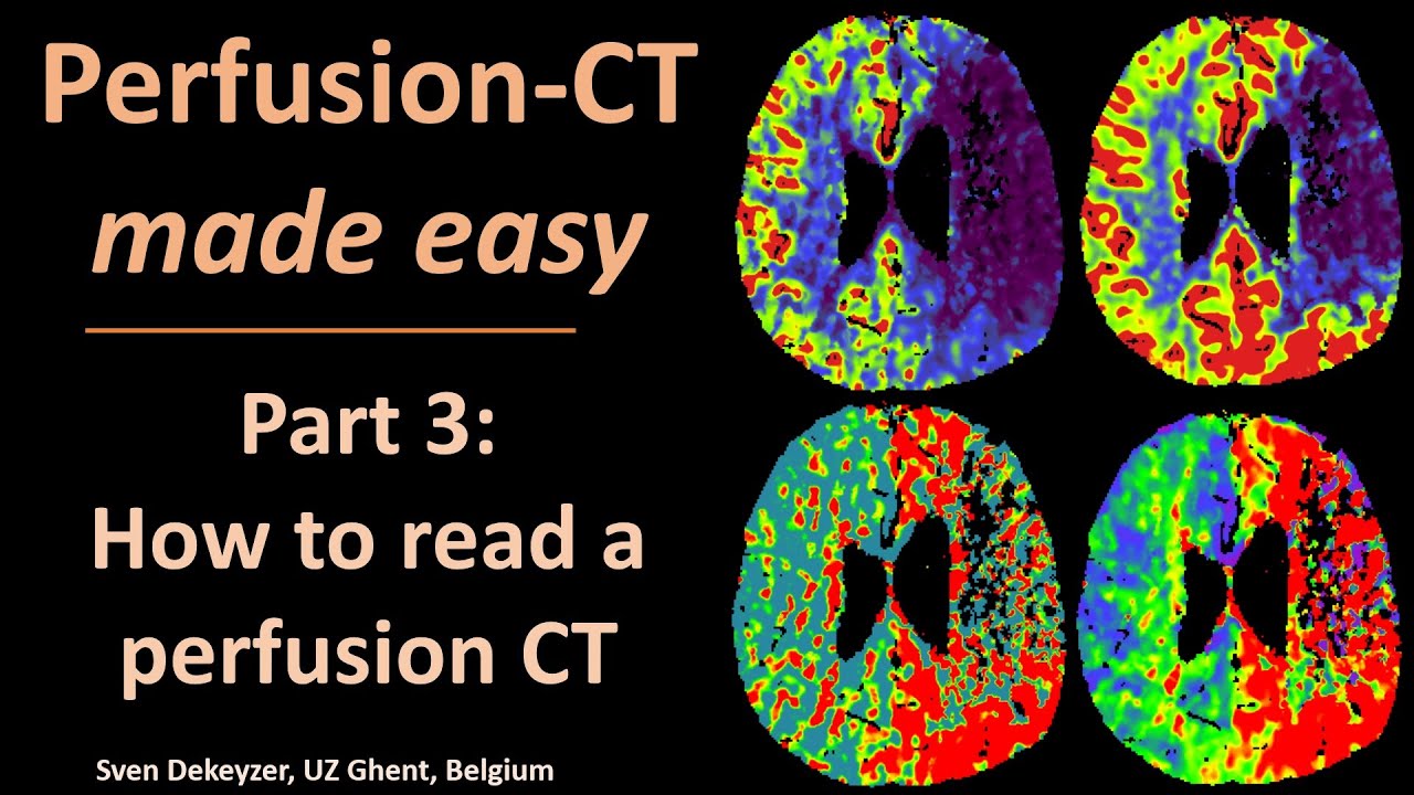 Perfusion CT made easy - part 3  - How to read perfusion CT?