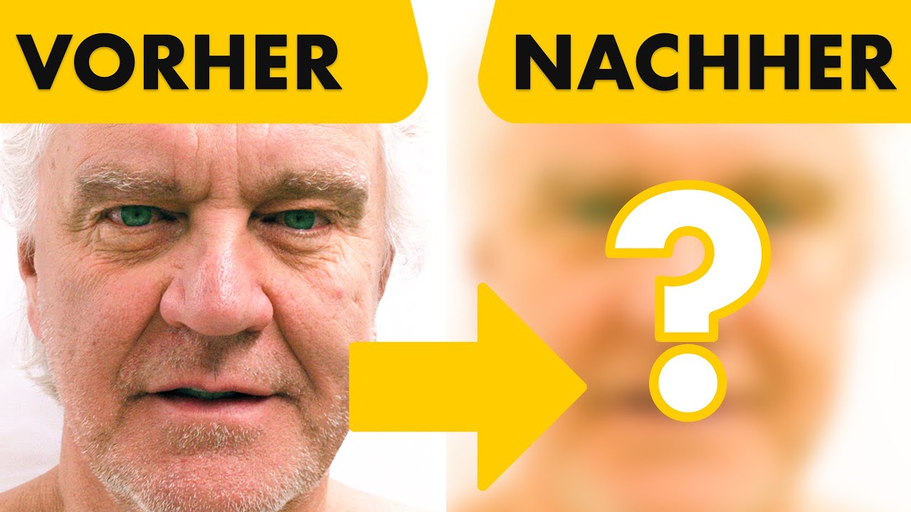 Ich mache ein Facelift bei meinem Lehrer! Vorher Nachher Ergebnis bei Dr. Bunkis | Dr. Jungwirth