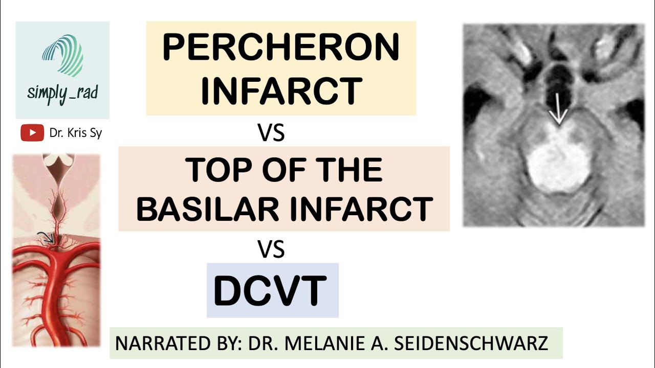 Percheron art infarct VS top of the basilar VS venous thrombosis