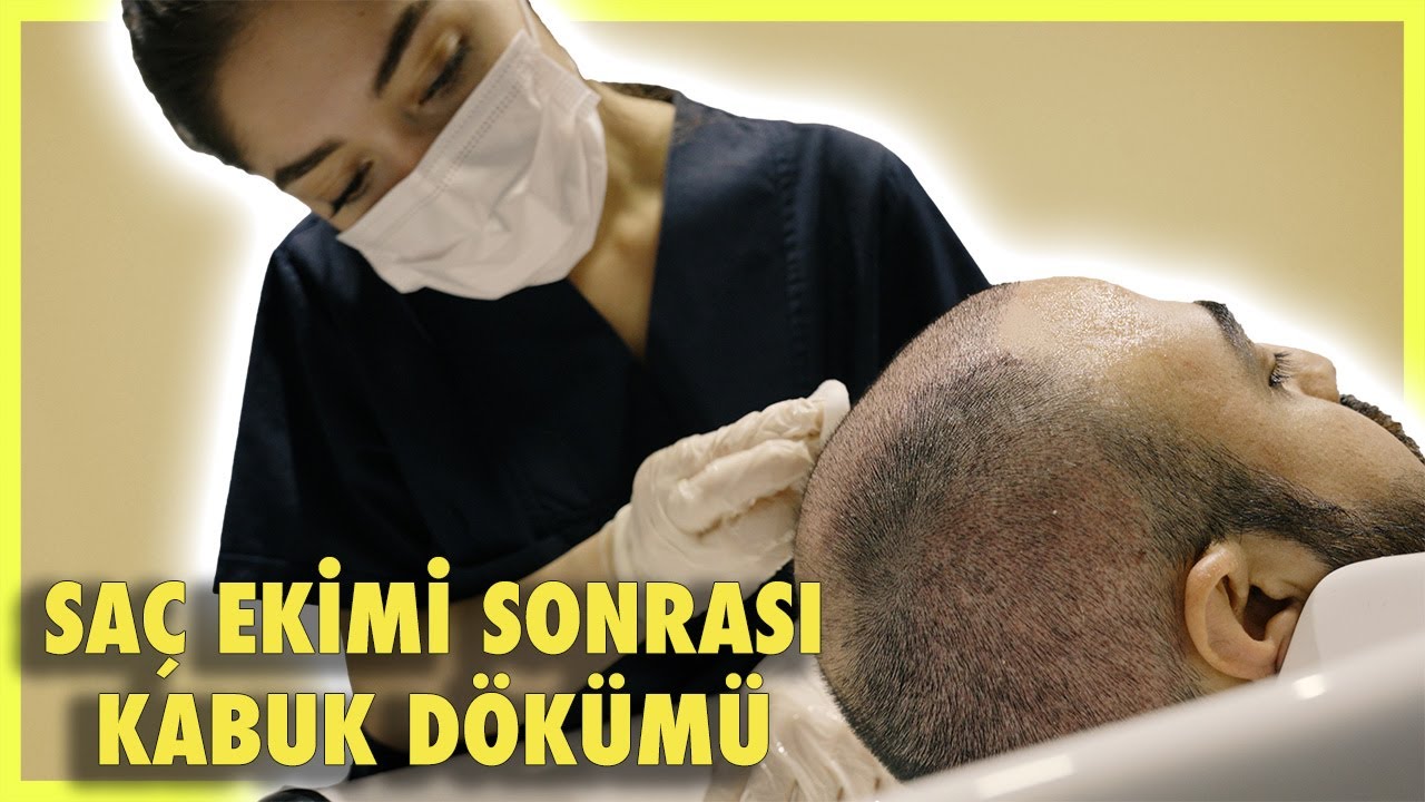 SAÇ EKİMİ SONRASINDA KABUK DÖKÜMÜ