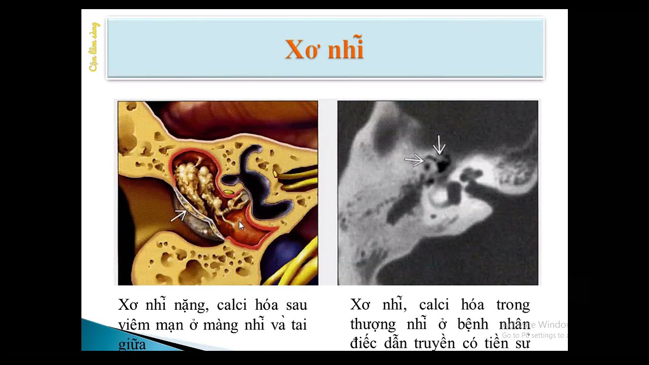 CLVT TAI - XƯƠNG CHŨM