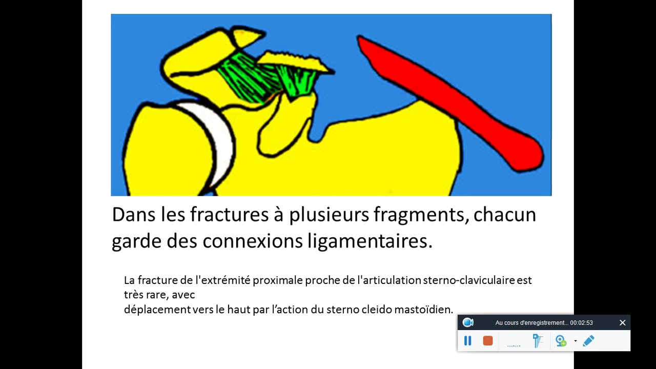 FRACTURES DE LA CLAVICULE