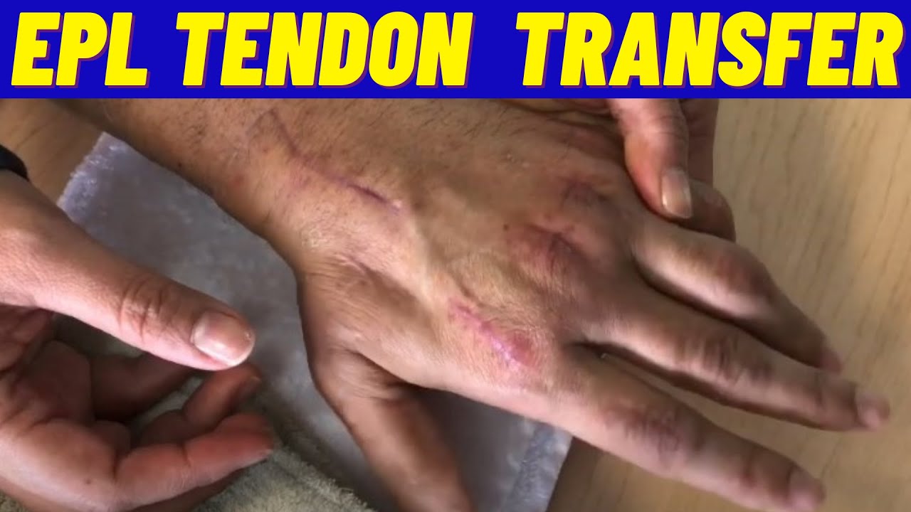 EPL Tendon Transfer at 4 Weeks, Post Crush Hand  Injury (Therapy)