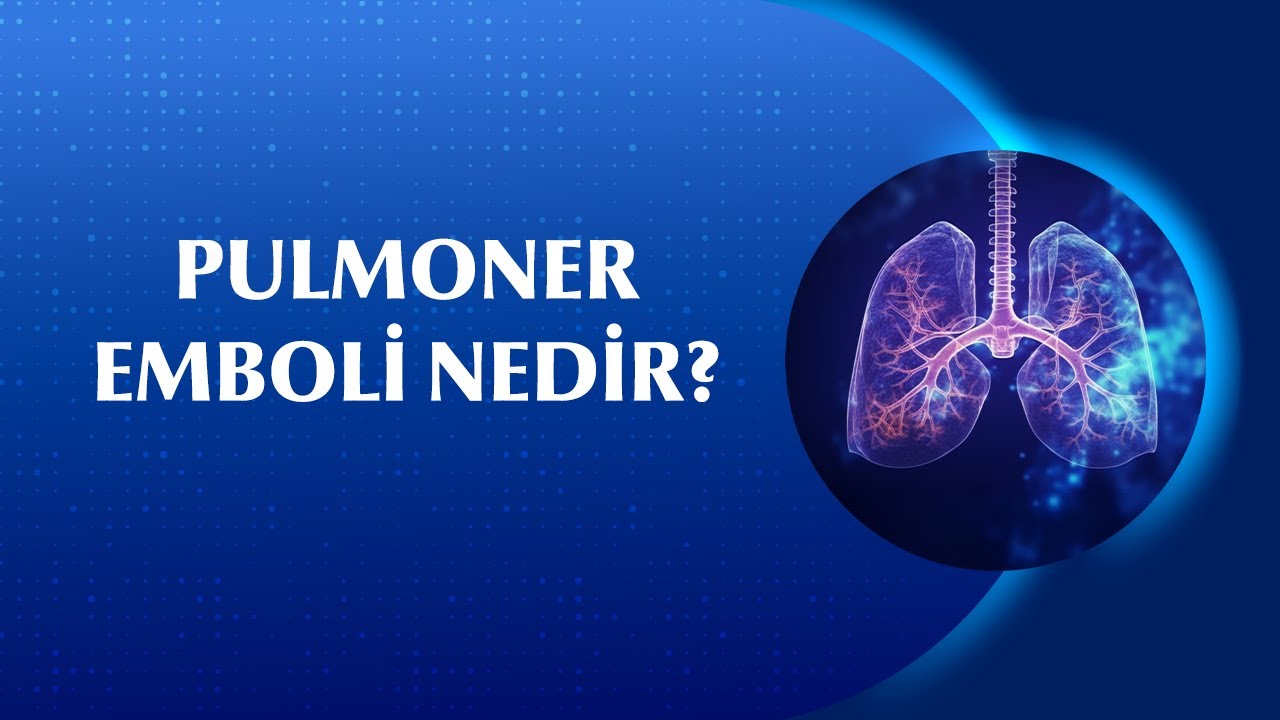 Pulmoner Emboli Neden Olur, Nasıl Tedavi Edilir?