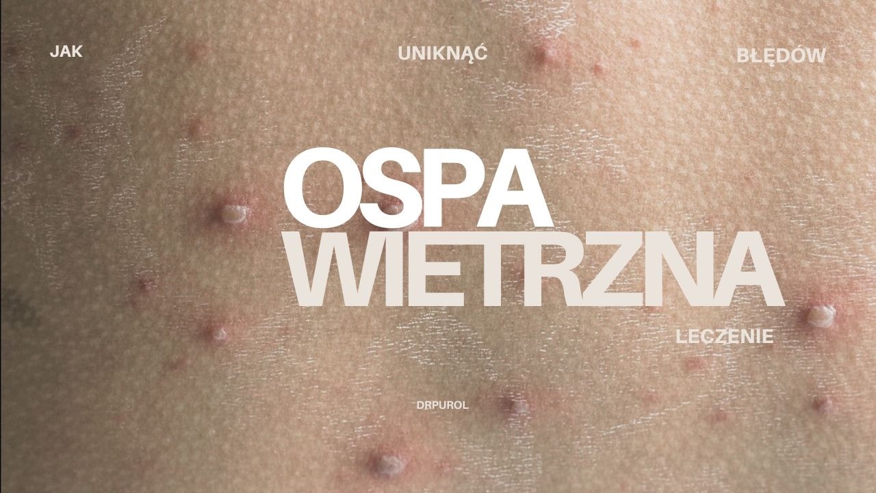 Jak prawidłowo leczyć ospę wietrzną - pediatra wyjaśnia