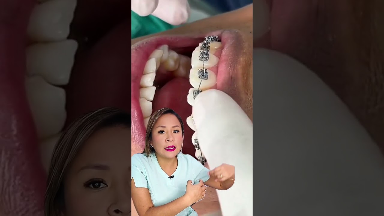 Brackets autoligables. 😁