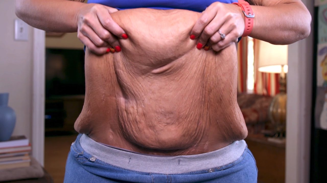 Holly Escaped An Abusive Home And Lost 200 Pounds, But Is Still Carrying Excess Skin