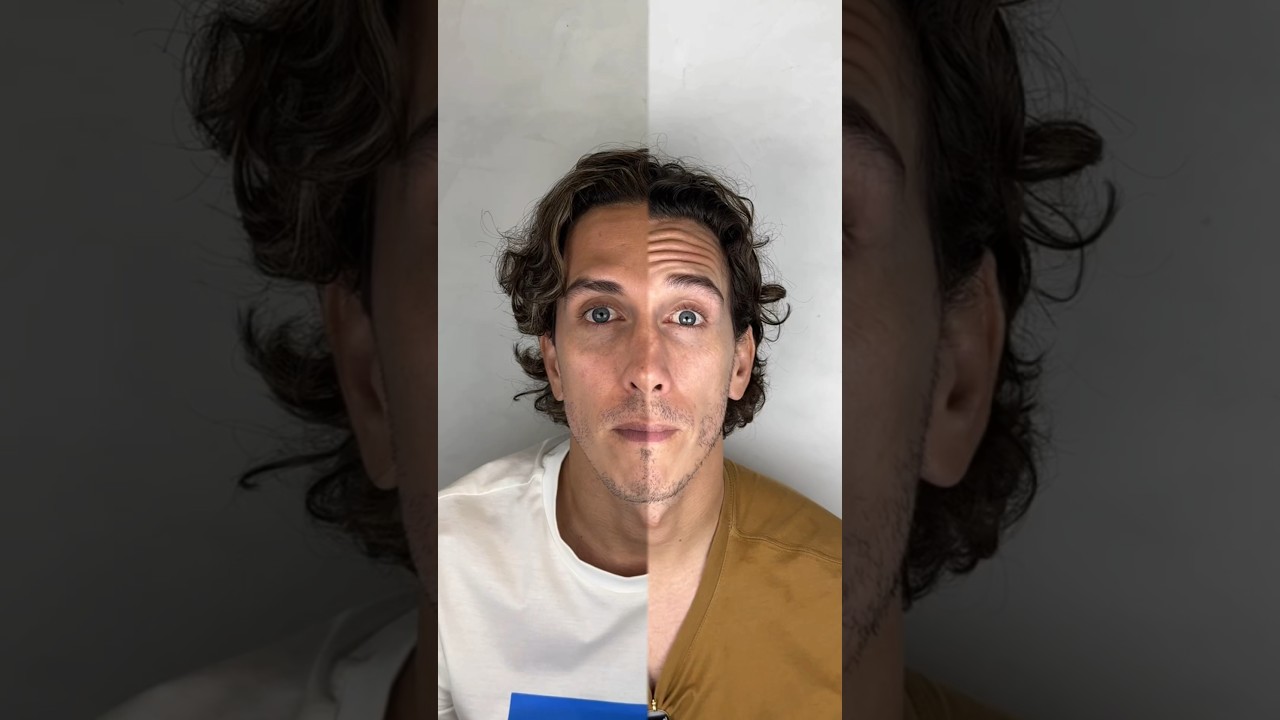 Resultado incr&iacute;vel desse tratamento de Botox em Fortaleza para preven&ccedil;&atilde;o e remo&ccedil;&atilde;o de rugas.