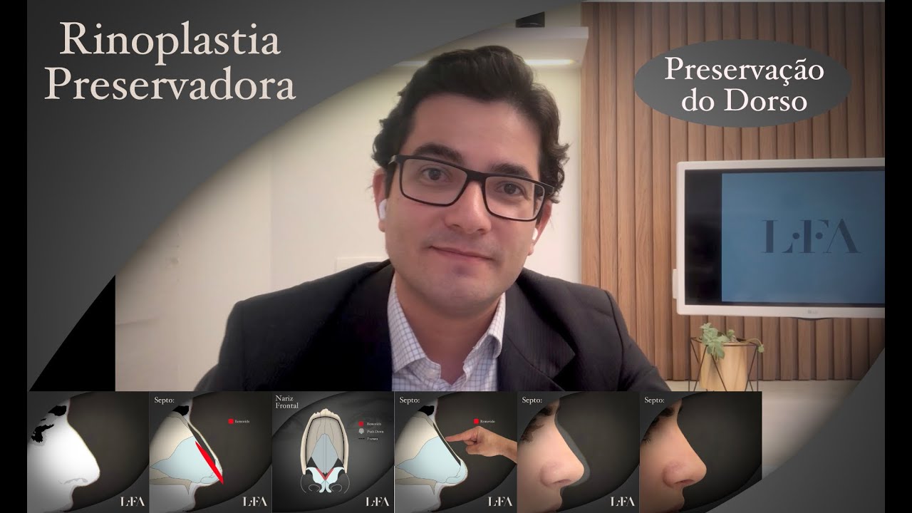 Rinoplastia Preservadora - Preservação do Dorso