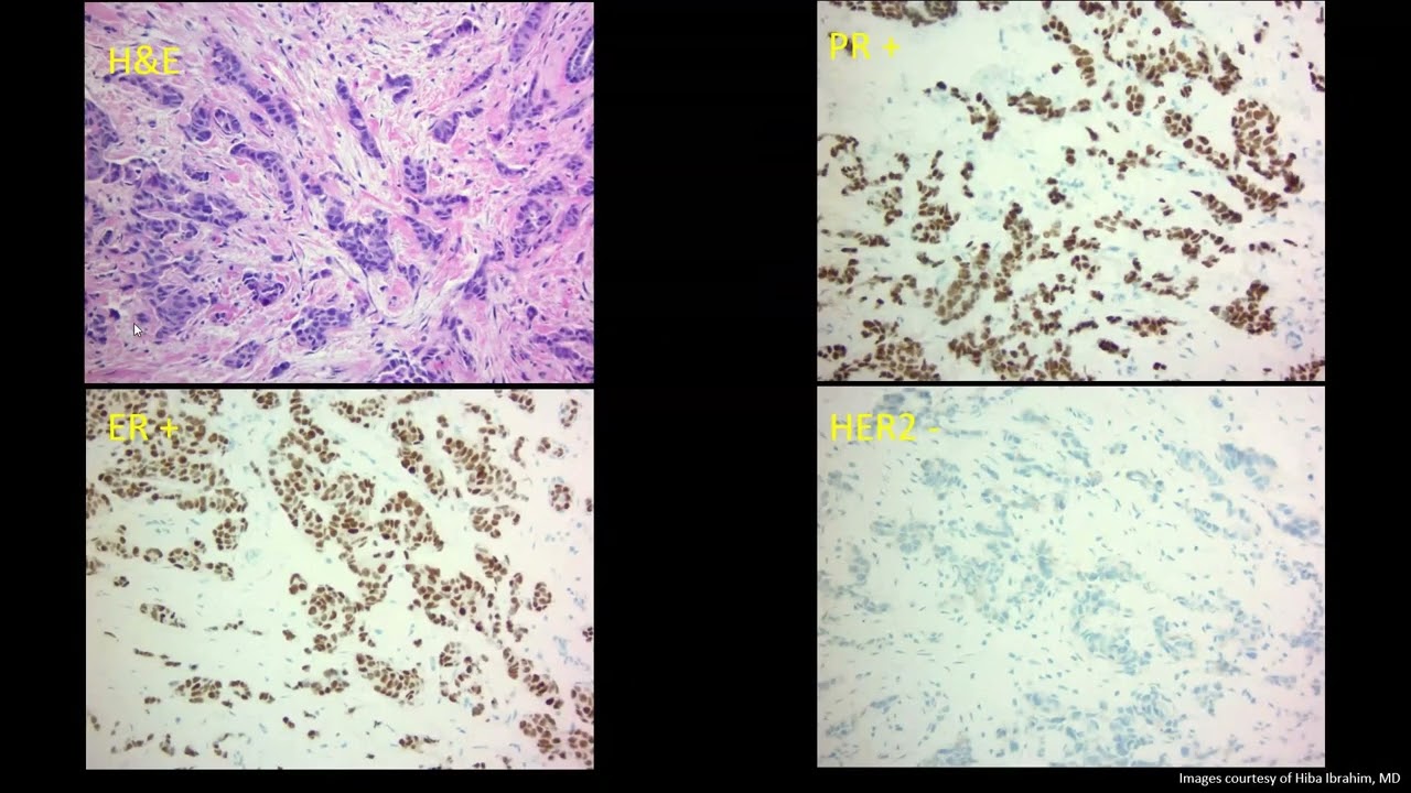 Introduction to the Molecular Subtypes of Breast Cancer - Sample