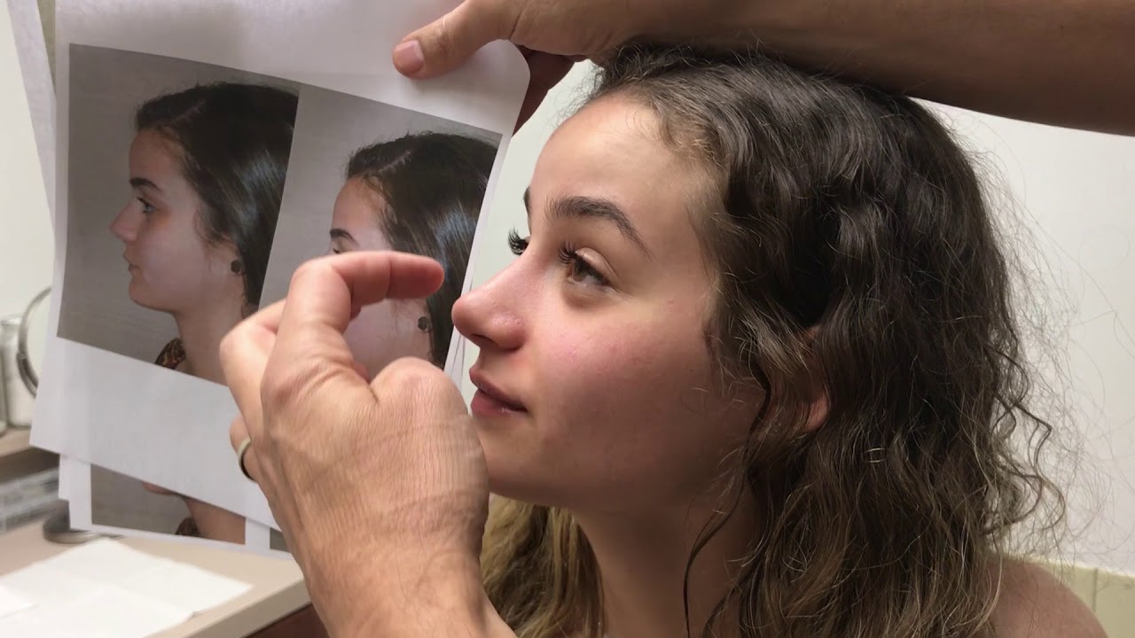 Rhinoplasty Result Compared to Computer Imaging