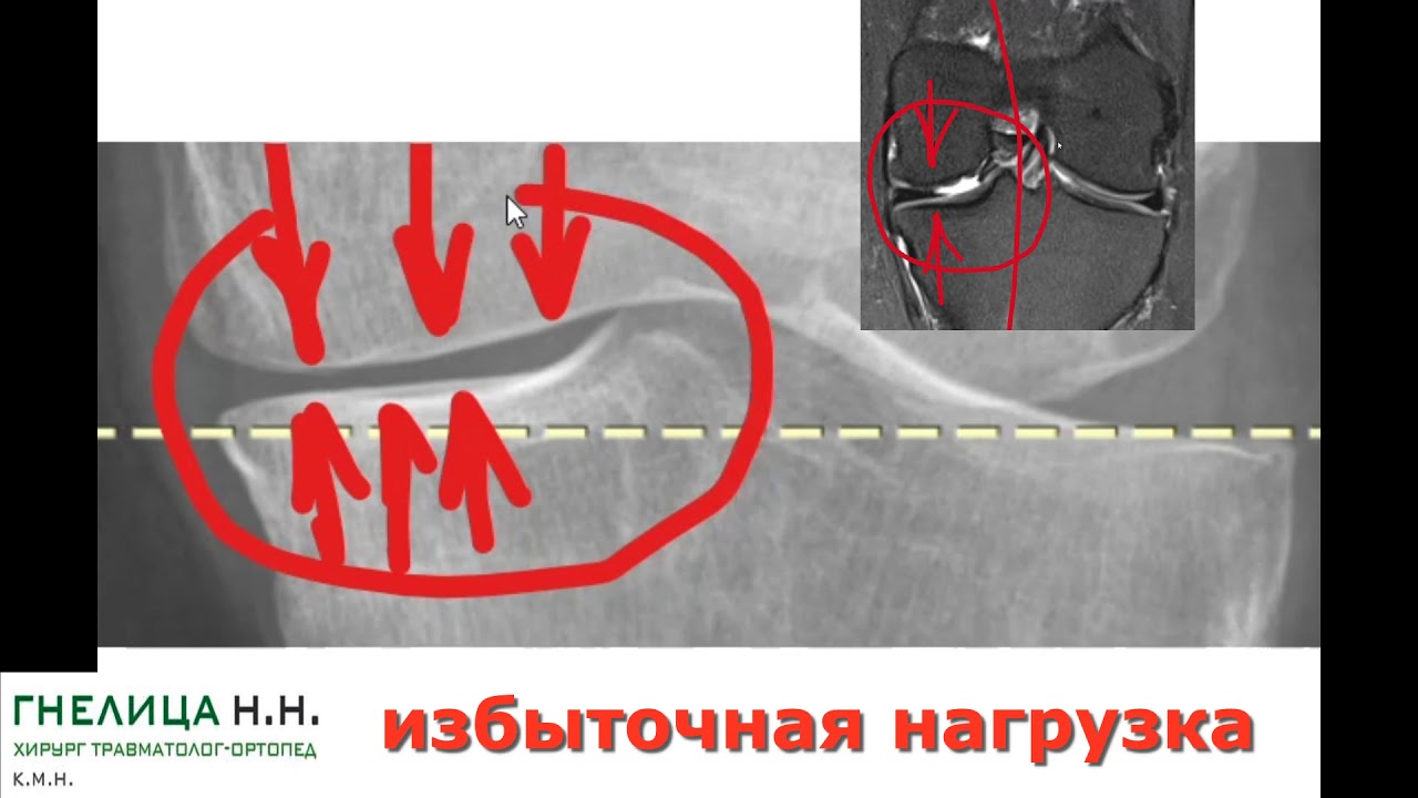 Высокая остеотомия голени: лечение и профилактика развития артроза/разрыва мениска коленного сустава