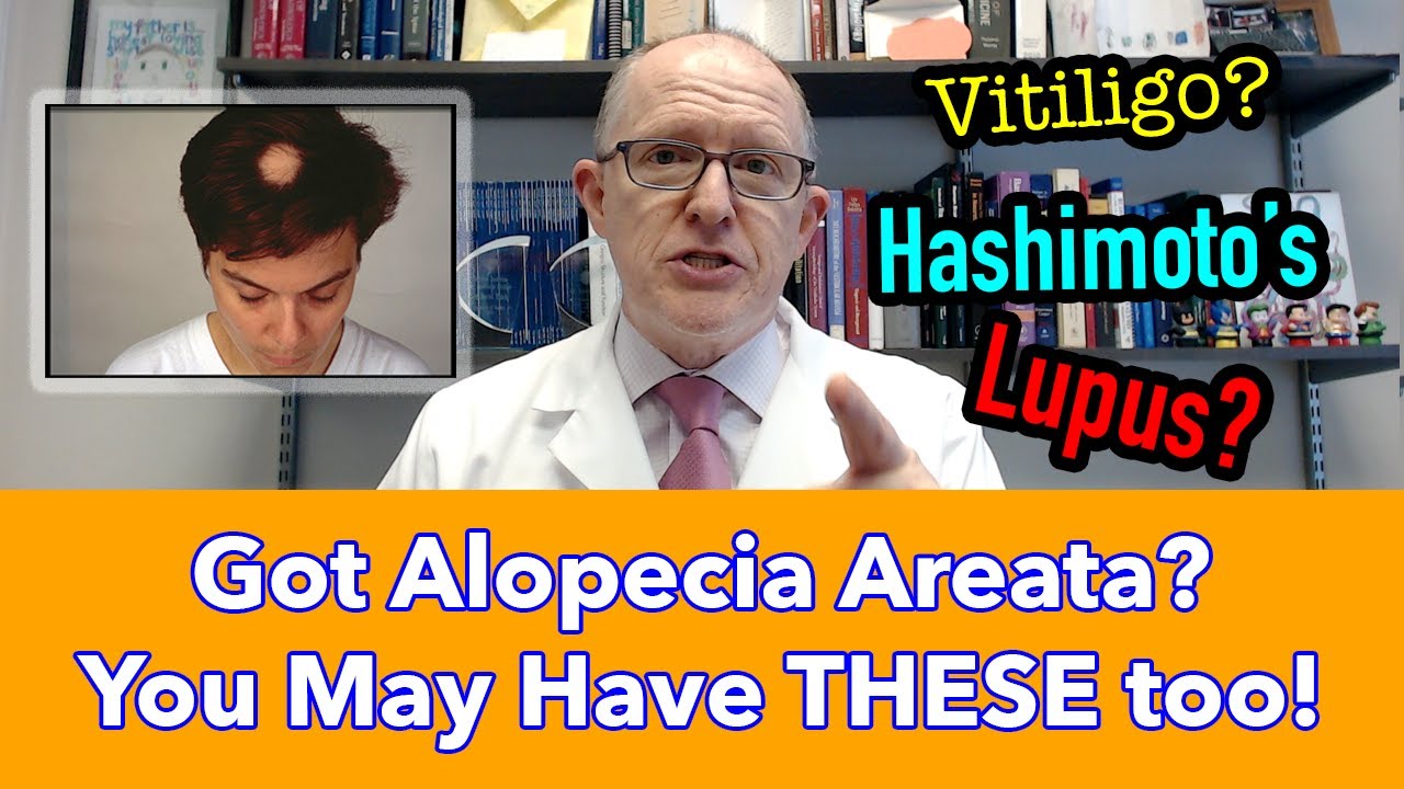 Got Alopecia Areata? You might have these autoimmune conditions TOO