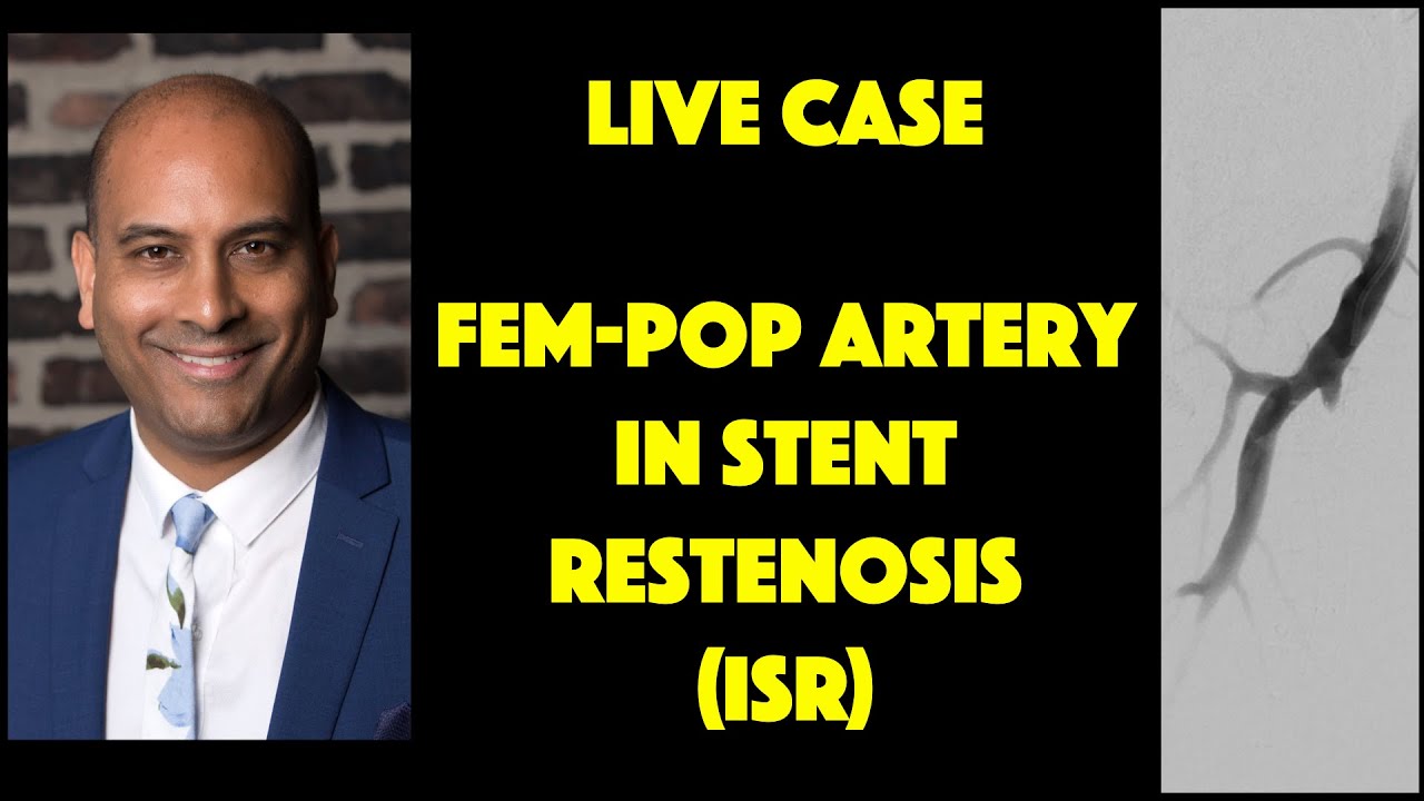 Live Case: FemPop Artery ISR (In-Stent Restenosis)