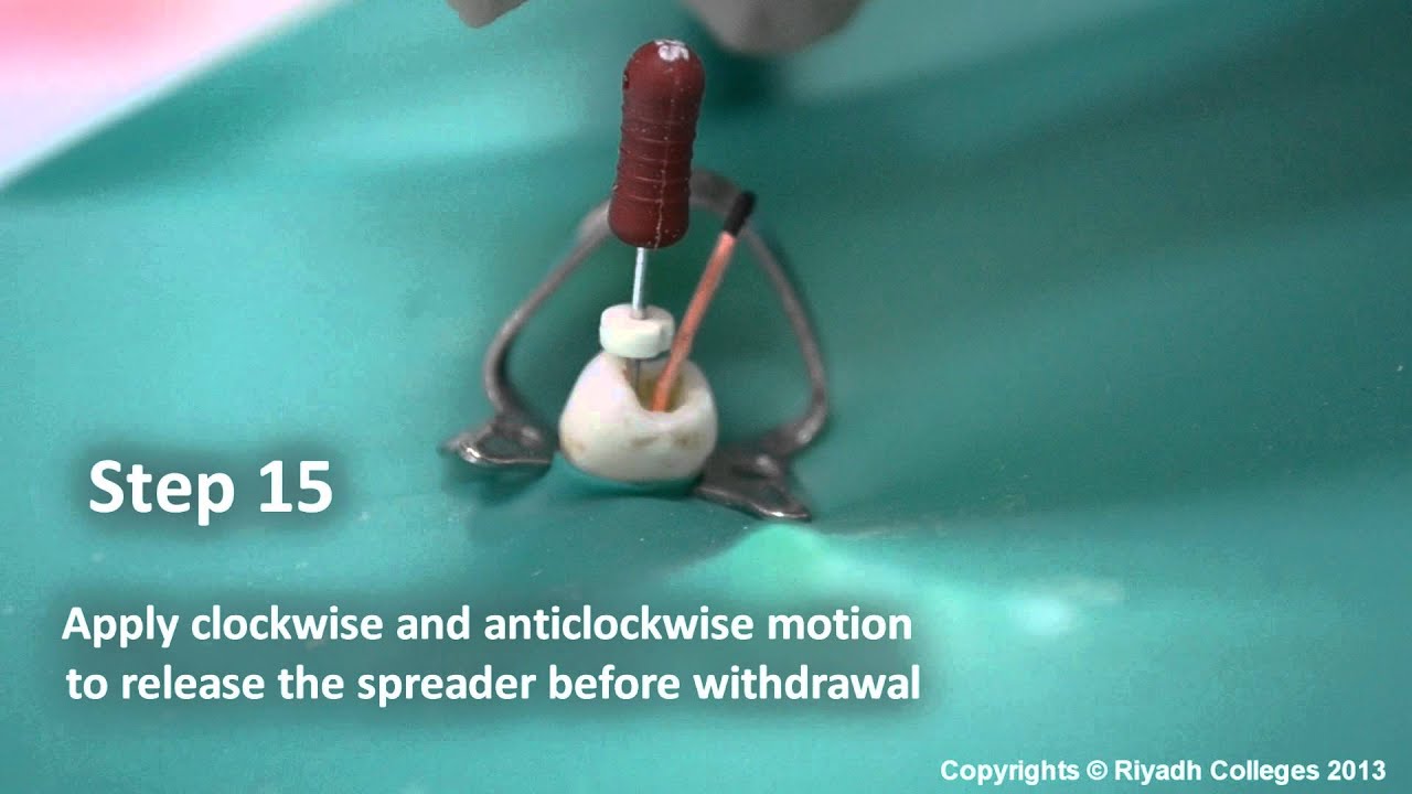 The Lateral Condensation Technique in 30 Steps