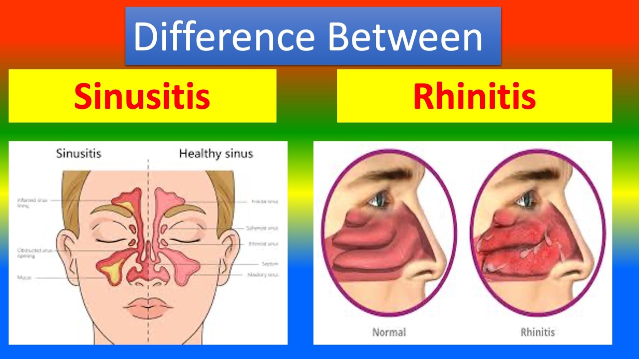 Difference between Sinusitis and Rhinitis