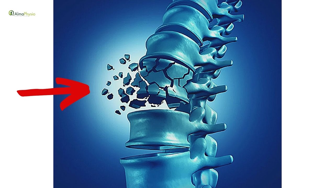 Schiacciamento vertebrale: riabilitazione