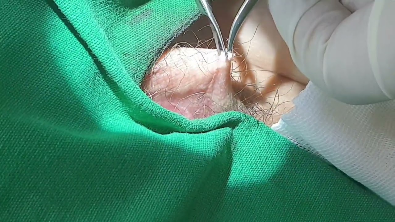 최소 절개란 이런 것