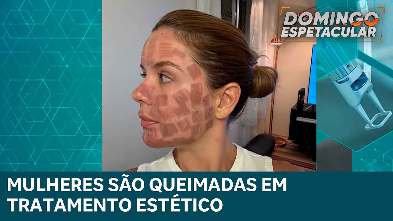 Mulheres sofrem queimaduras graves durante procedimento est&eacute;tico com laser de CO2