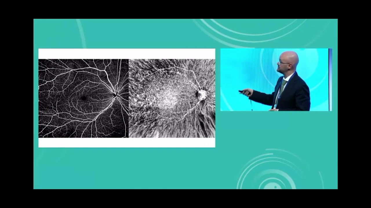 SSOCT Enface Choroidal Vasculography 