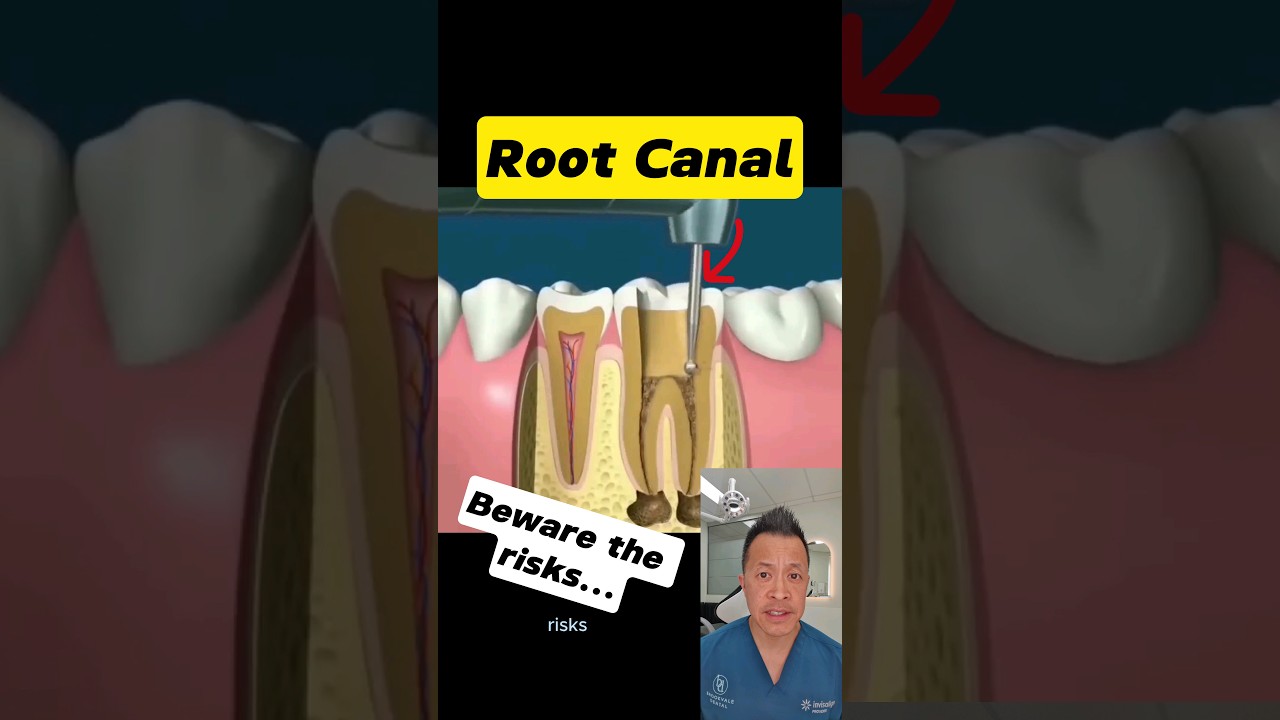 Root Canal Dangers: What Your Dentist Might Not Tell You #dentallan #dentist #shorts