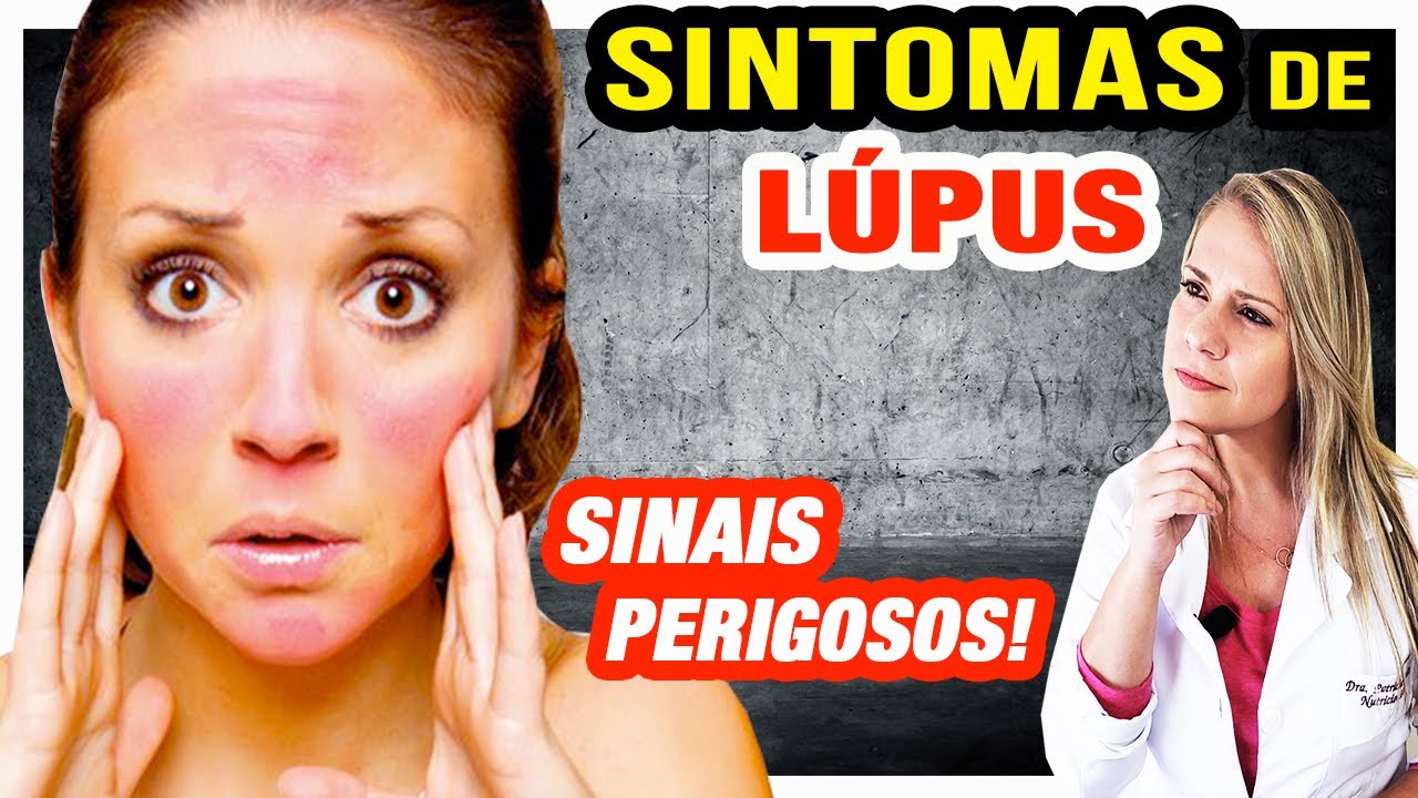 Sintomas de Lúpus [SINAIS PERIGOSOS PARA PRESTAR ATENÇÃO]