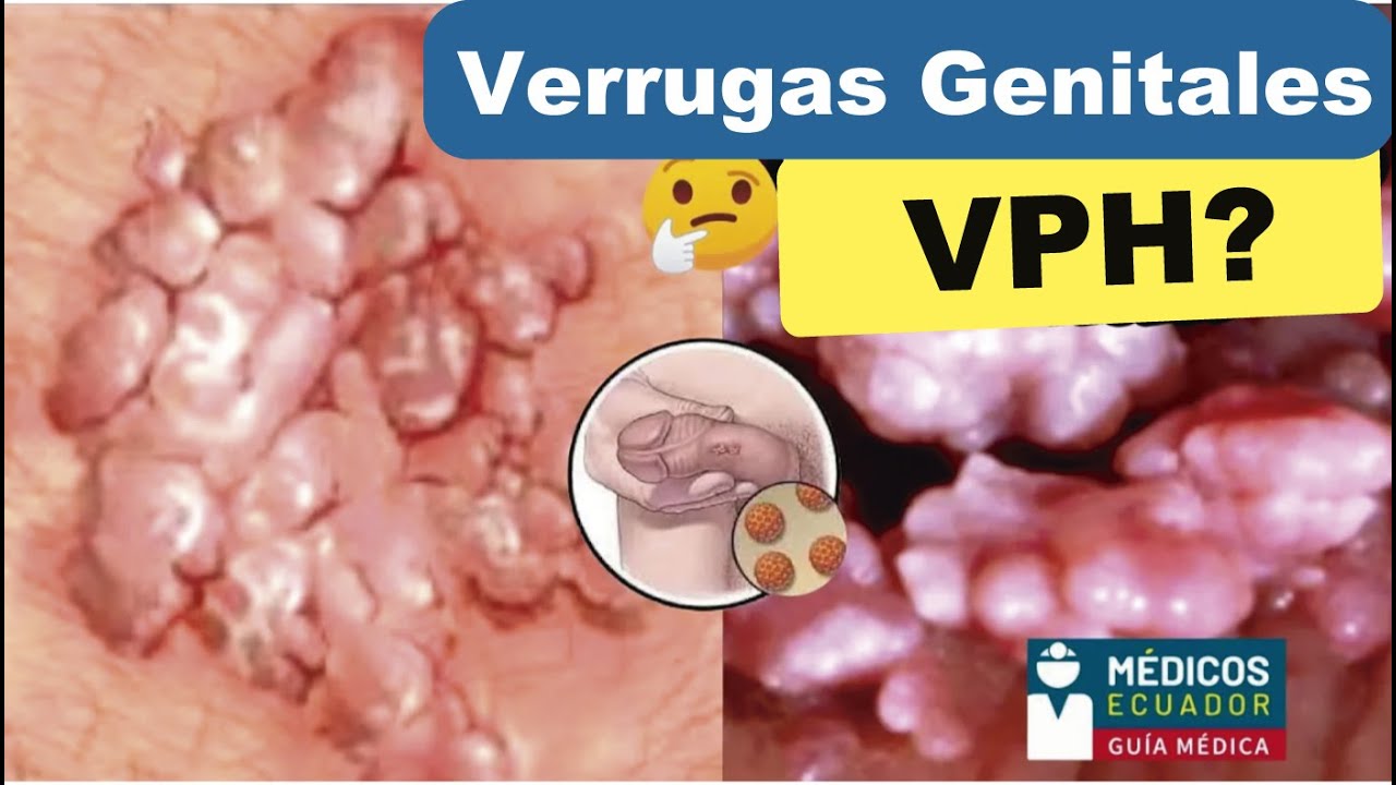 VERRUGAS GENITALES  en Mujer y Hombre VIRUS PAPILOMA HUMANO #Guayaquil #vagina #vph