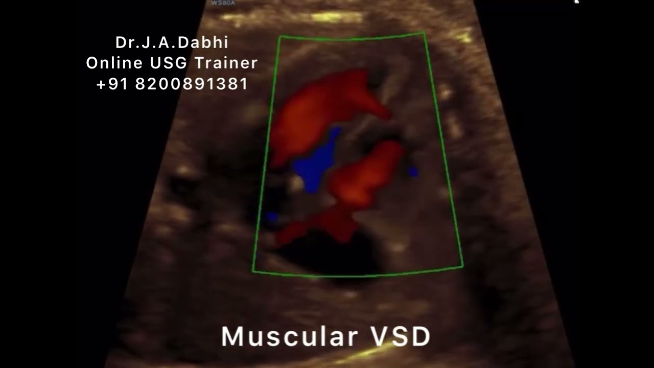 Muscular VSD