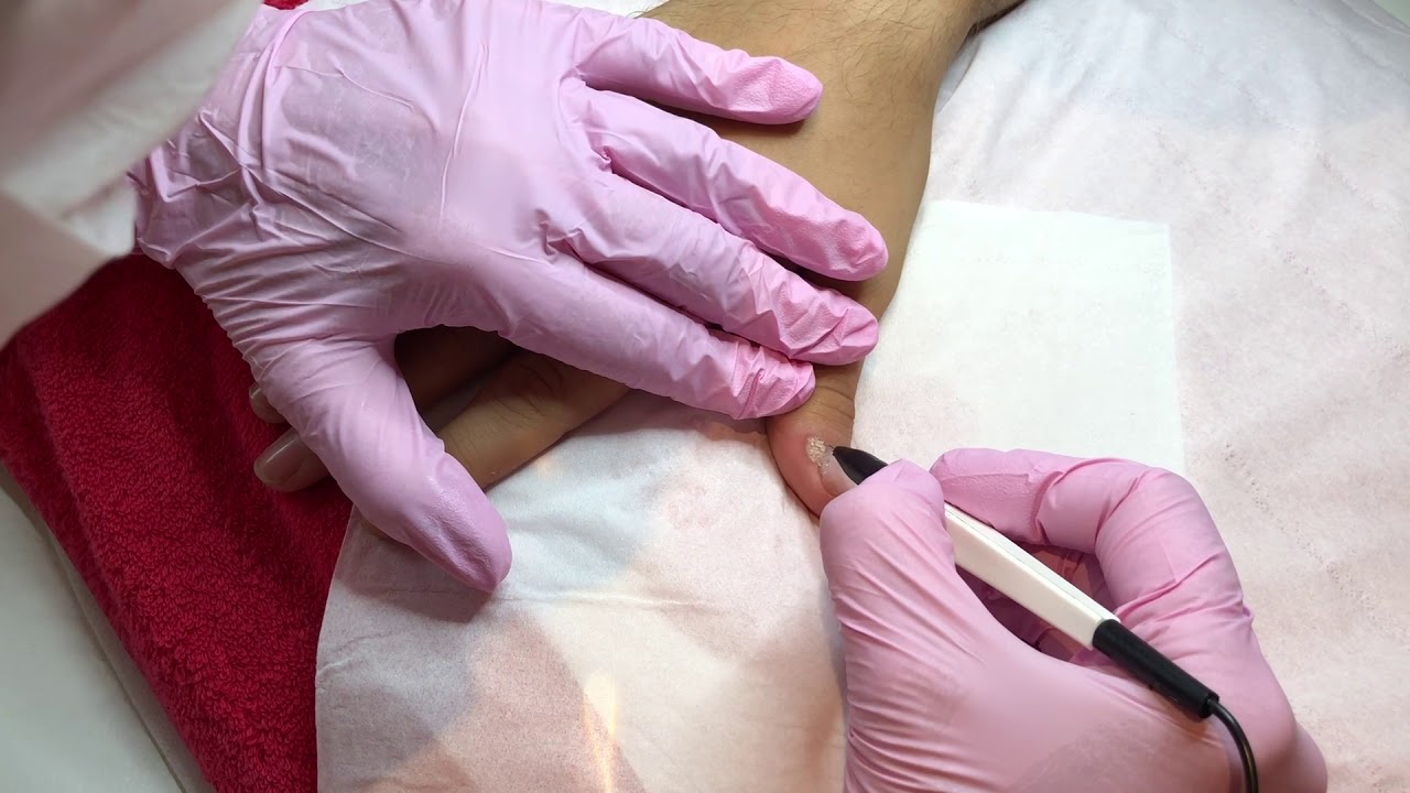 Wart Removals on the Thumbs | Appearances Aesthetics